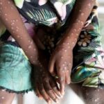 Variole du singe : six nouveaux cas recensés à La Réunion en un mois
